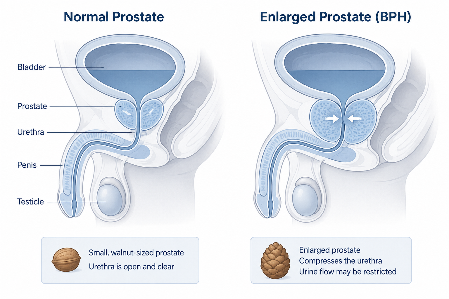 Medical illustration comparing a normal prostate with an enlarged prostate pressing on the urethra