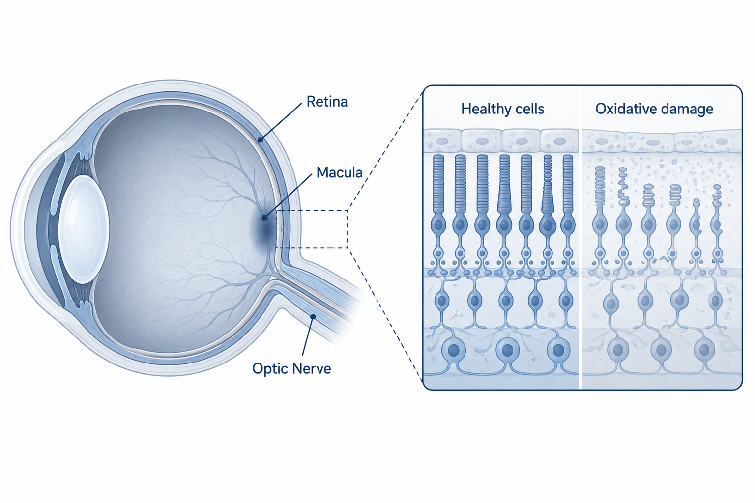 Medical illustration of the human eye showing the macula and retina, with oxidative damage highlighted